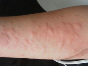 胆碱能性荨麻疹怎么治疗