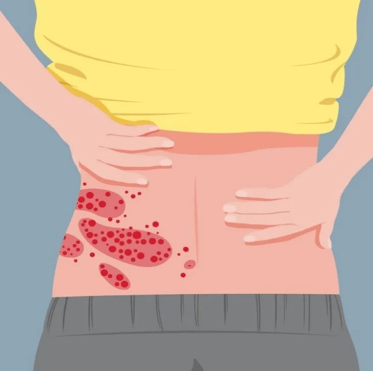 蛇缠腰疱疹如何治疗？|厦门看皮肤病哪里好