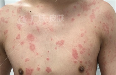 急性荨麻疹是什么原因引起的
