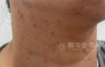 胸口长痘是怎么回事
