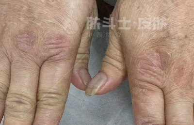 脚上皮肤痒越抓越痒是什么情况