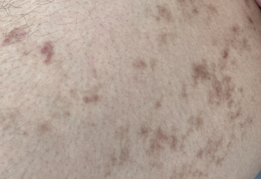 沉淀黑色素怎么去除