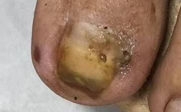 大脚趾甲往肉里长怎么处理