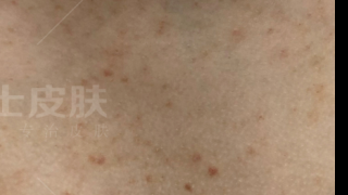 胸上长痘是什么原因引起的