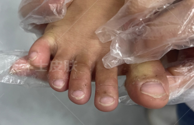 脚起水泡发痒是怎么回事