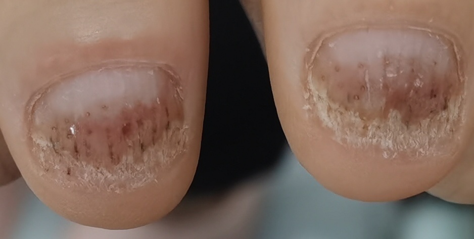 手指长灰指甲是什么原因