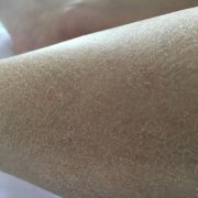 鱼鳞病有哪些症状
