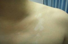 白癜风有哪些症状
