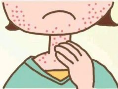 皮炎是怎么形成的