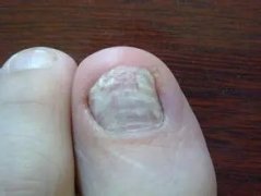 灰指甲有哪些危害性