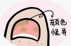 怎么判断是否患上灰指甲