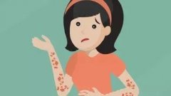 带状疱疹怎么治疗好