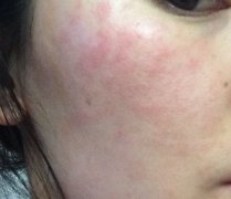 厦门脸过敏哪里看的好