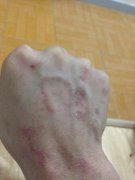 冬季手癣发作怎么办