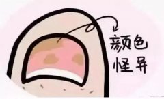 厦门看灰指甲比较好的医院