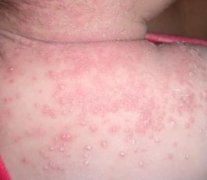 儿童湿疹预防方法有哪些