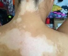 白癜风疾病的常识