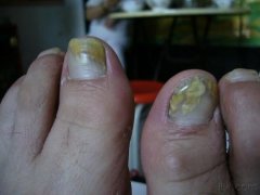 灰指甲的危害有哪些