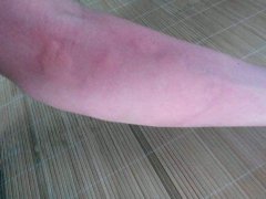 厦门荨麻疹治疗好的医院