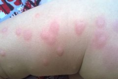 为什么荨麻疹更喜欢夏天