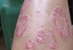 银屑病患者的日常生活保健护理措施是什么