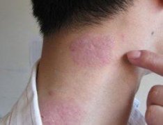牛皮癣有什么危害