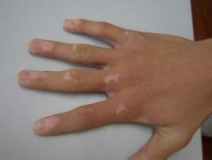 白癜风患者应怎样护理
