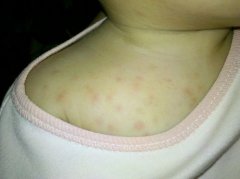 如何有效预防湿疹