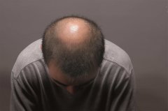 头顶脱发严重日常怎么补救