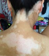 白癜风患者该如何护理