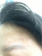 改善青春痘有哪些办法