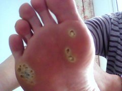 鸡眼是什么引起的