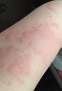 荨麻疹是什么造成的