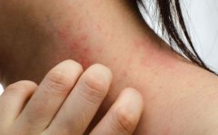 女生毛囊炎怎么治疗