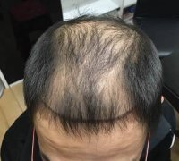 脱发怎么治疗
