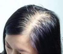 脱发怎么治疗呢