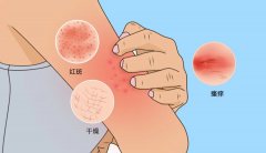 皮肤过敏怎么治疗