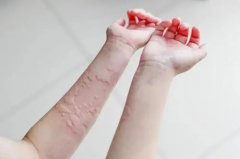 荨麻疹患者要如何护理皮肤呢